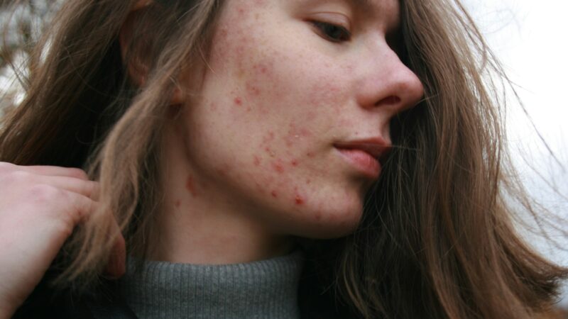 Acne Treatment in Singapore