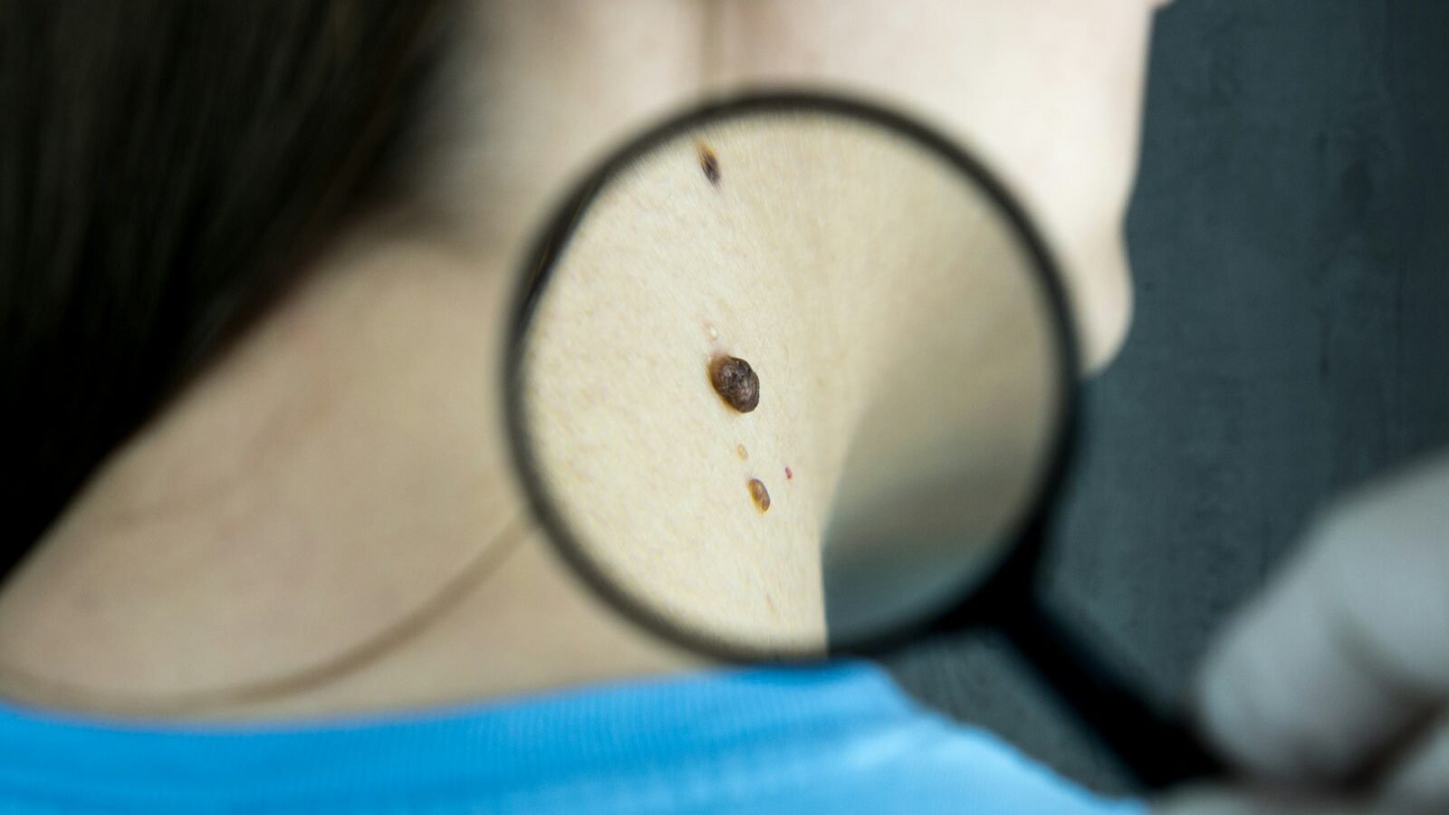 Seeing a Dermatologist in Singapore