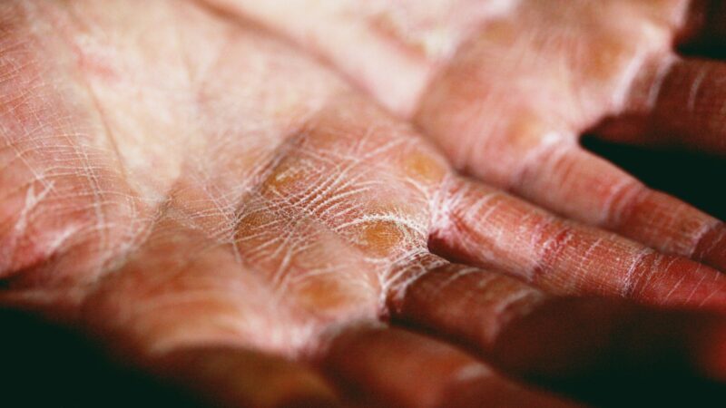 Managing Eczema in Singapore’s Humid Climate