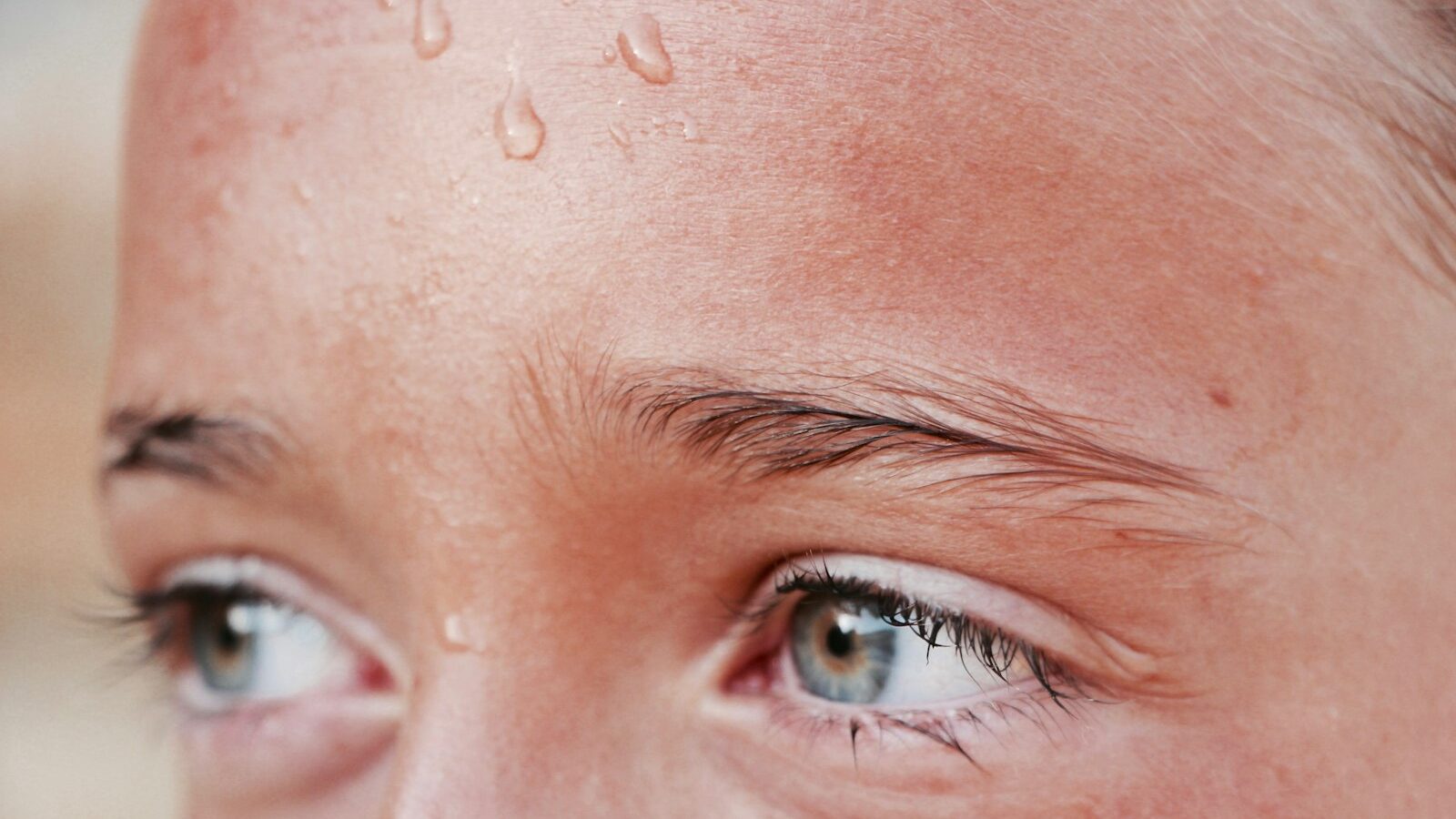 Perioral Dermatitis Explained