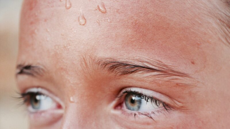 Perioral Dermatitis Explained