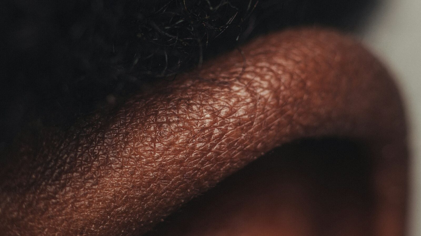 Sebaceous Filaments vs Blackheads