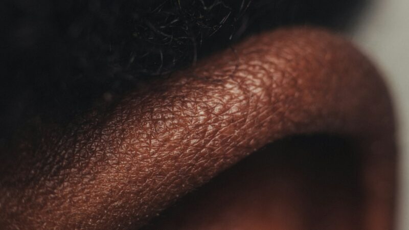 Sebaceous Filaments vs Blackheads